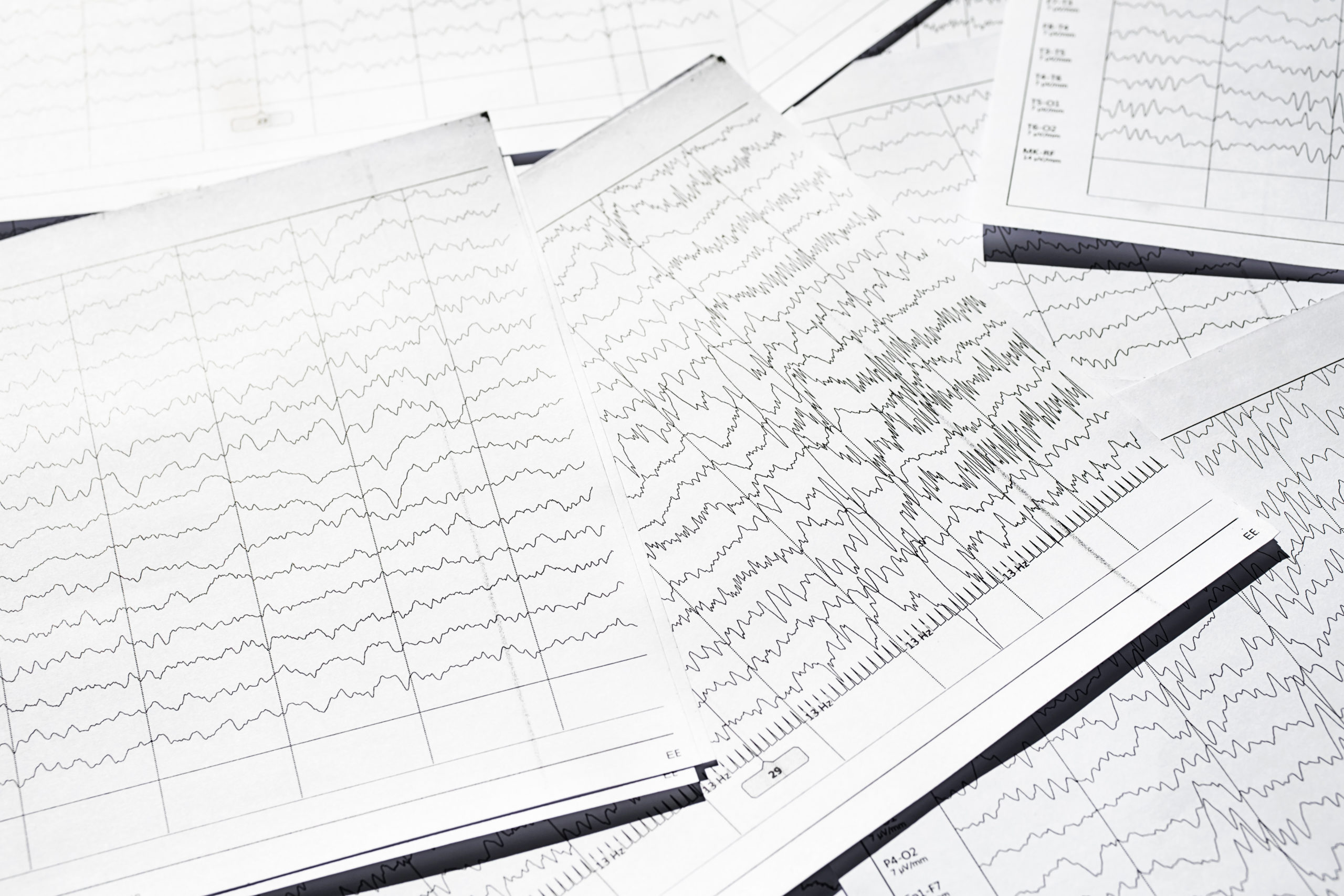 Electroencephalogram diagnostic rezults after epilepsy. Brain wave patterns on EEG.