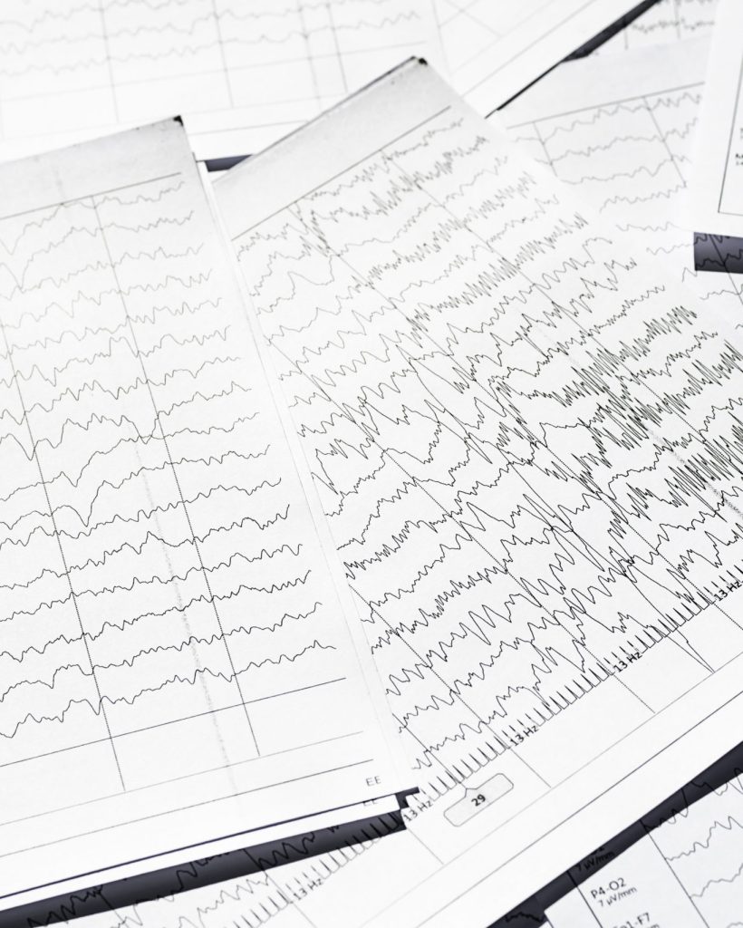 Electroencephalogram diagnostic rezults after epilepsy. Brain wave patterns on EEG.